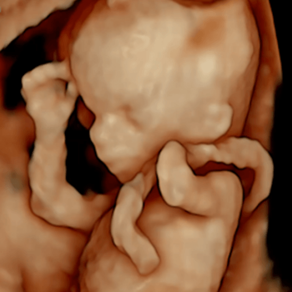 Baby with missing left hand at 12 week early pregnancy scan.