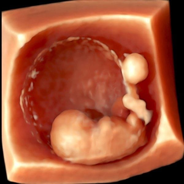 3D ultrasound of an early pregnancy showing the embryo inside the pregnancy sac