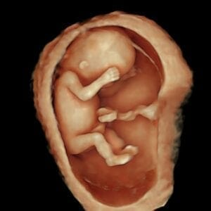3D ultrasound image of a baby in the womb at 12 weeks