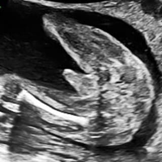 The History of Ultrasound in Obstetrics and Gynaecology
