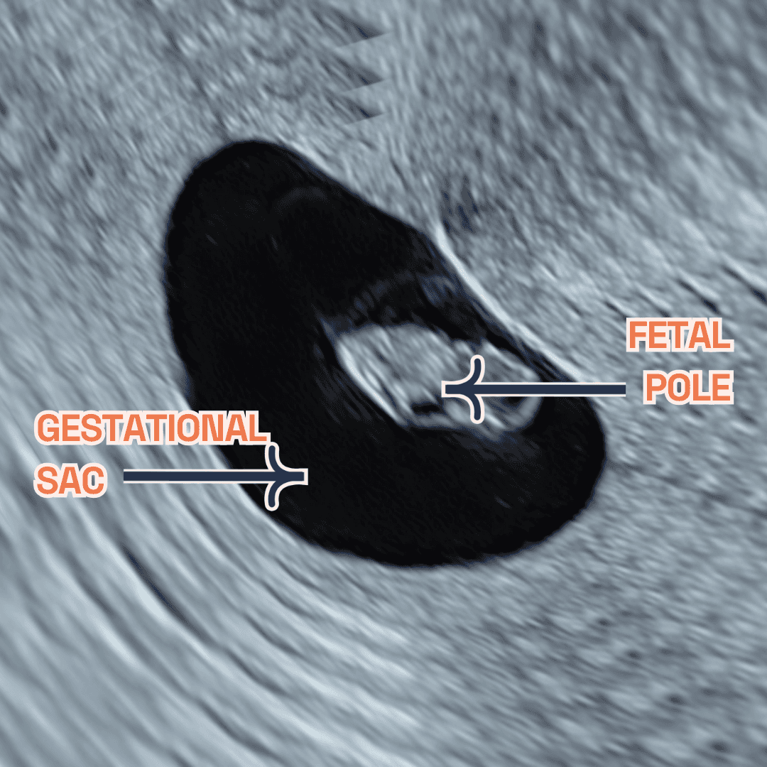 Image showing what would an ultrasound show at 7 weeks of pregnancy. It shows an Ultrasound image by London Pregnancy Clinic that shows the gestational sac, fetal pole and yolk sac - for educational purpose.