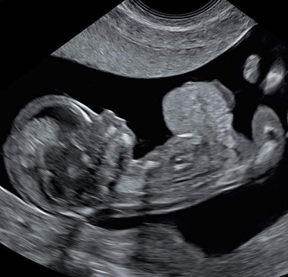 Exomphalos with liver at 12 weeks