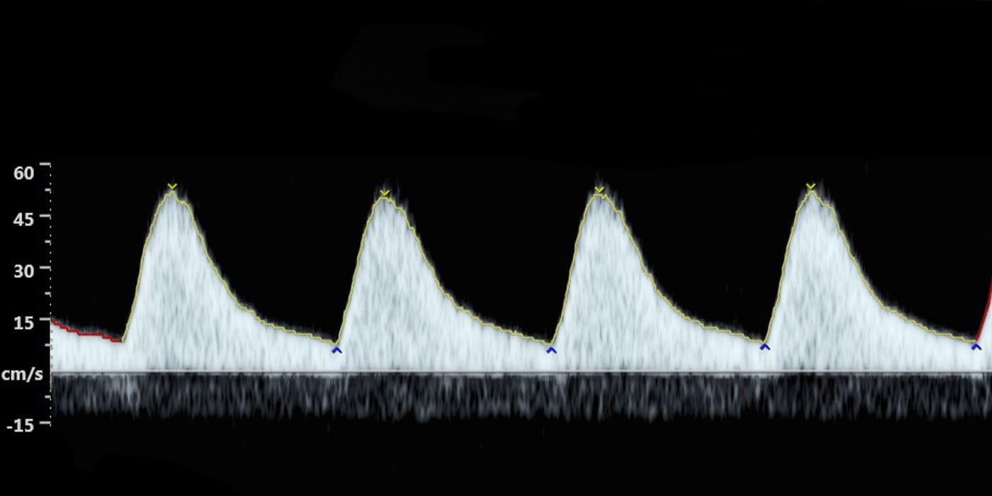 Doppler Scan spectrogram image that shows flow velocity (cm/s) against time. 