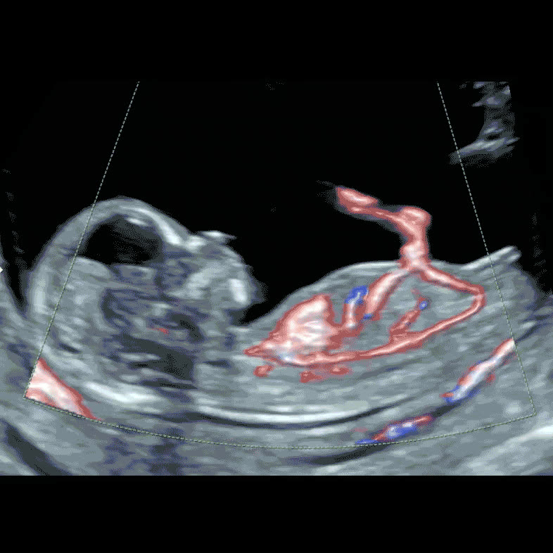 Colour Doppler image of fetal heart circulation at 13 weeks