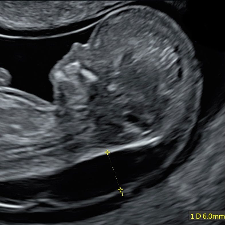First-trimester ultrasound image of a baby in profile with a nuchal translucency measurement marked
