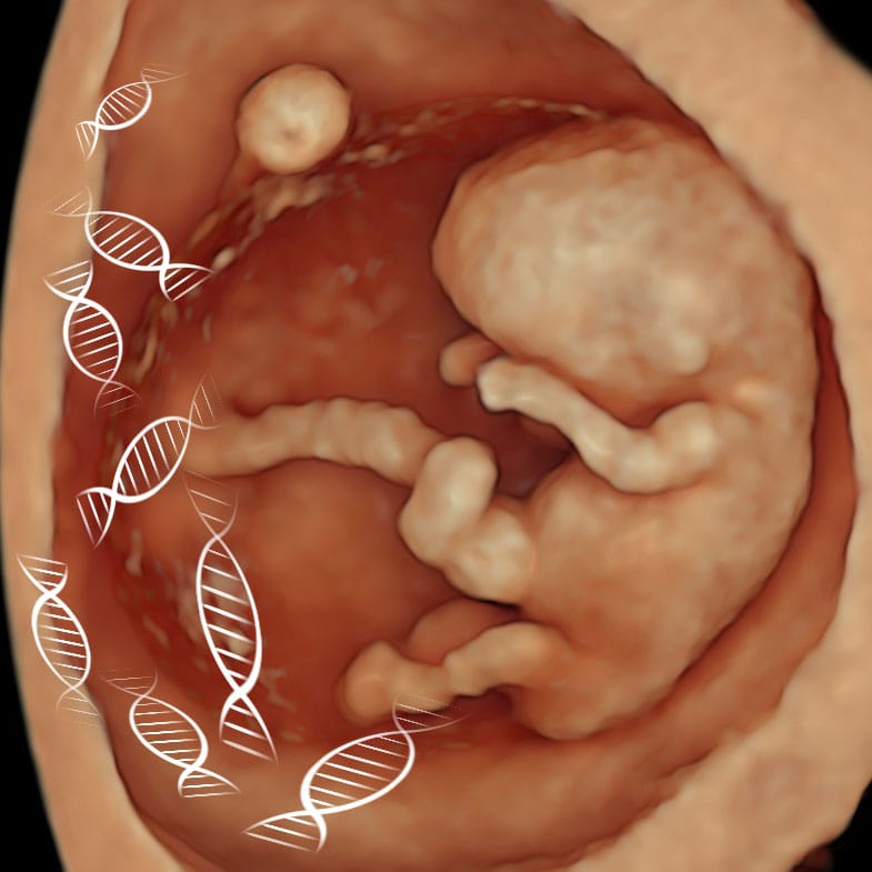 NIPT scan at London Pregnancy Clinic — chromosomal and structural screening combined