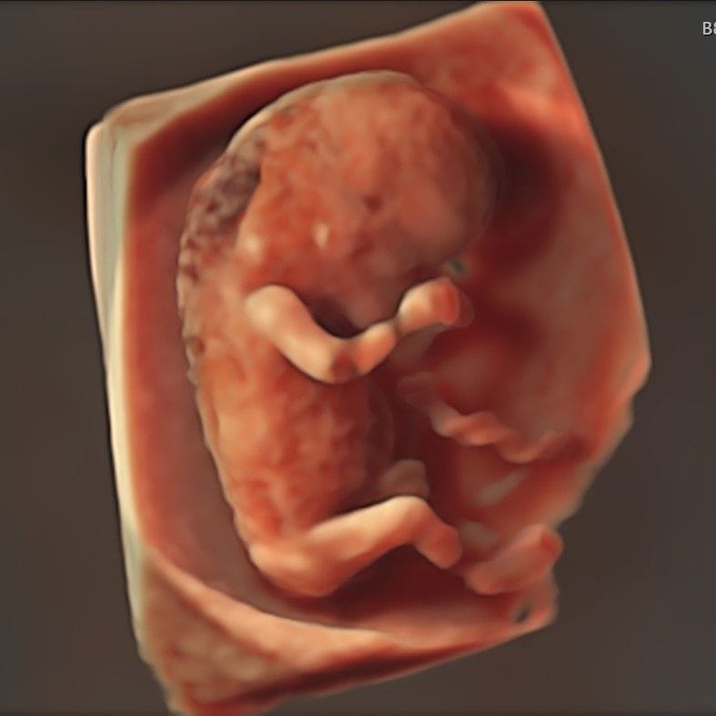 Baby with Increased NT visualised in 3d at 10-11 Week Scan