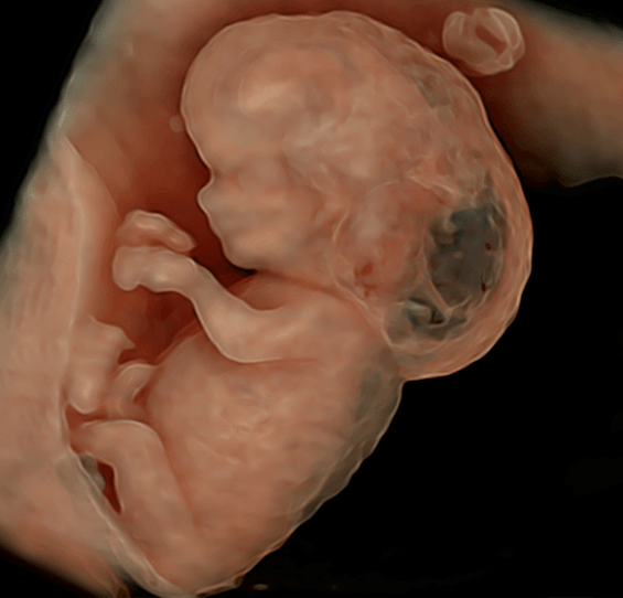 Cystic hygroma - abnormal NT - hydrops - 11wk