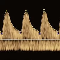 Doppler Scan