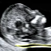 Nuchal Scan