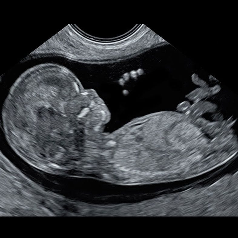 Baby scan for cleft lip 