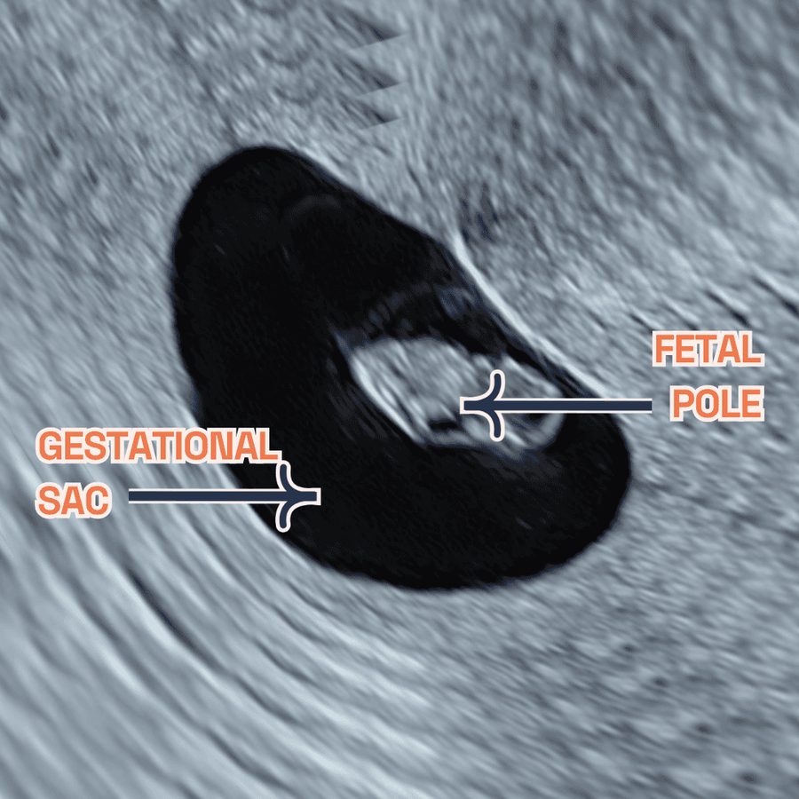 Black-and-white early ultrasound with labels pointing to the gestational sac and the fetal pole