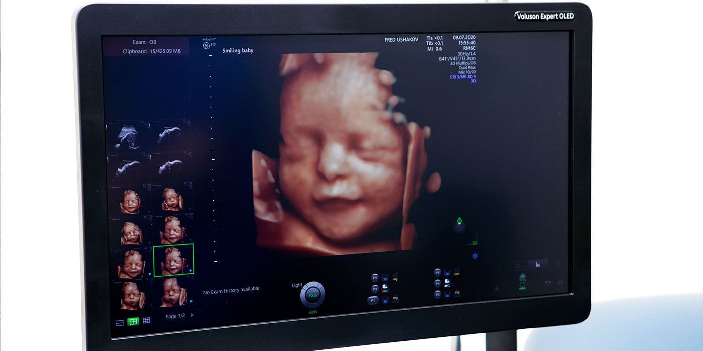 Real 3D ultrasound performed at London Pregnancy Clinic