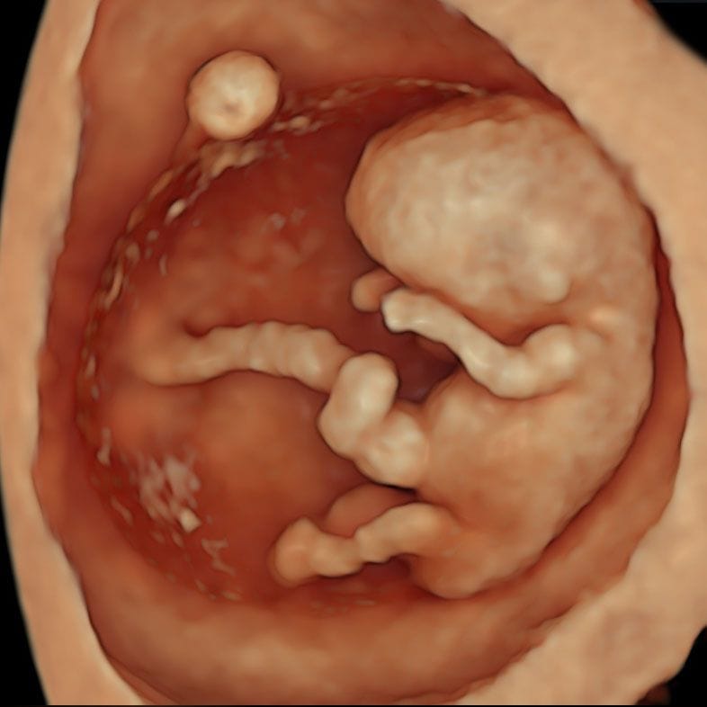 Our NIPT + Early Anomaly Scan always incorporates chromosomal anomaly and structural screening from as early as 10 weeks