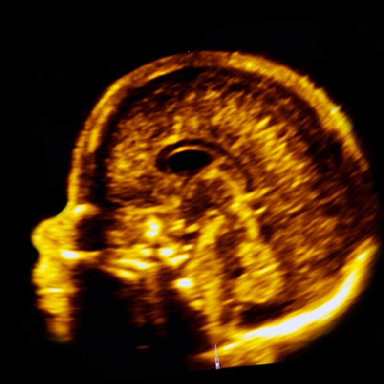 Sonographer performing a detailed fetal anomaly scan of the baby's head and brain