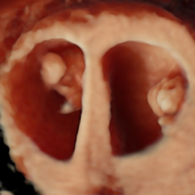 Twin pregnancy captured in 3D at our clinic (7 weeks)