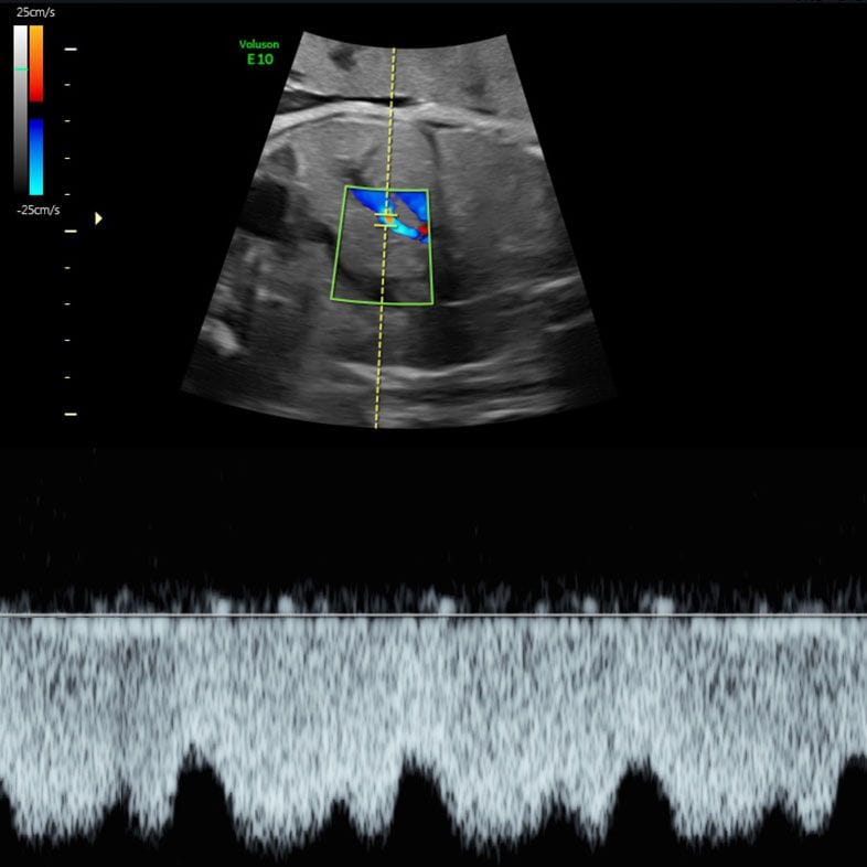 Doppler waveform showing blood flow in a fetal vessel during a growth assessment