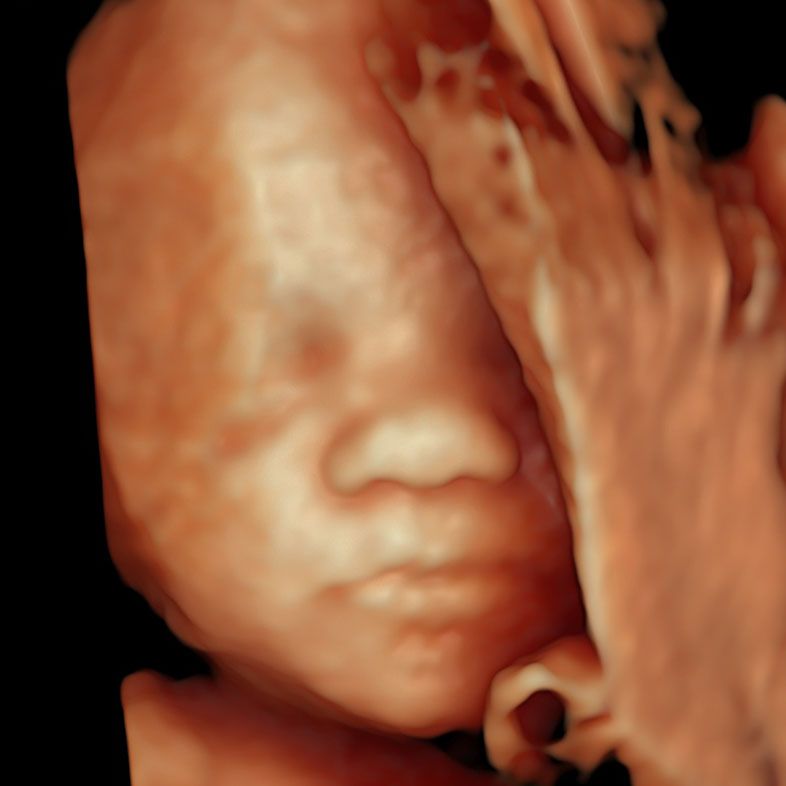 3rd Trimester Ultrasound Scan 3d at 26 weeks of pregnancy done at London Pregnancy Clinic.