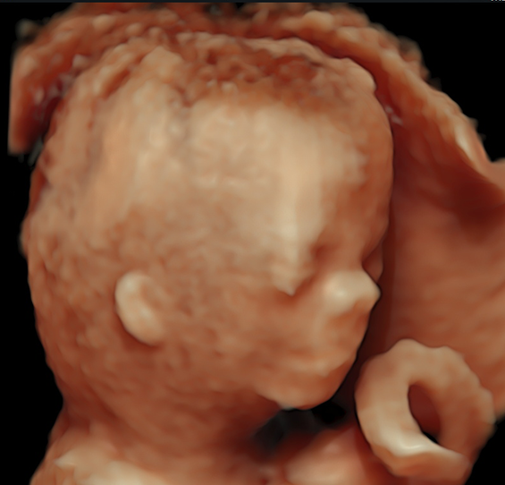 3d 4d ultrasound down syndrome