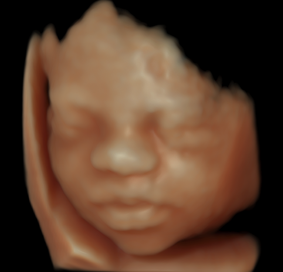 Down-syndrome-4D-scan-at-26-week