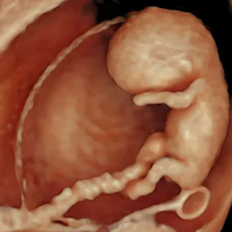 10–11 weeks: Our revolutionary 10 Weeks Anomaly Scan