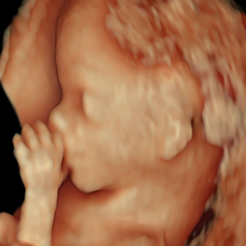 3D ultrasound image of a 14-week-old fetus, showcasing detailed features and development