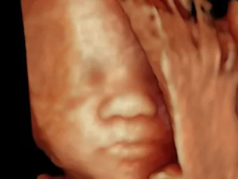20+ weeks: 2nd & 3rd Trimester scans