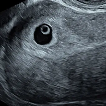 4–5 weeks: Too early for a scan