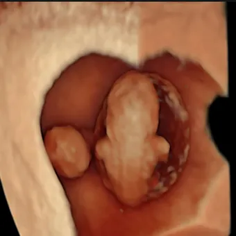 6–9 weeks: Your first scan — Dating/Viability Scan
