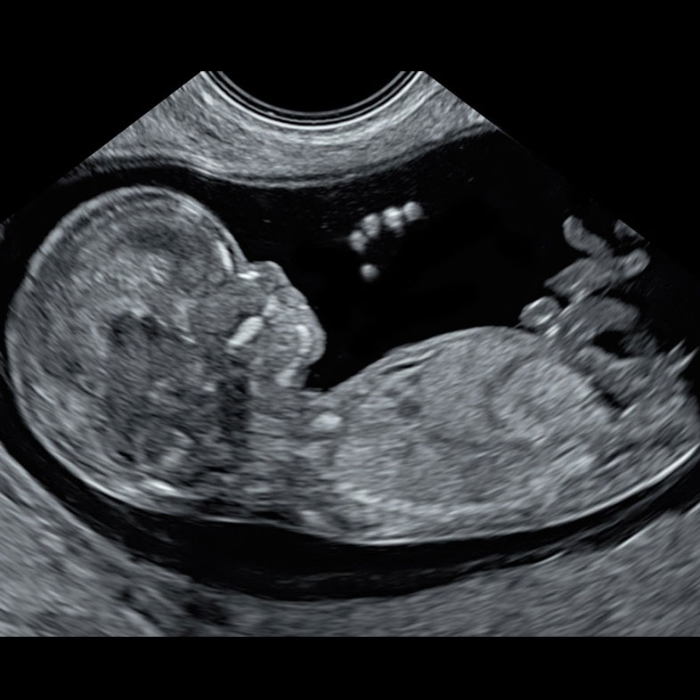 Ultrasound scan image of a baby at 13 weeks. You can see the amazing definition of the scan, showing the individual fingers of the baby. At this stage the baby is about the size of a plum (7cm).