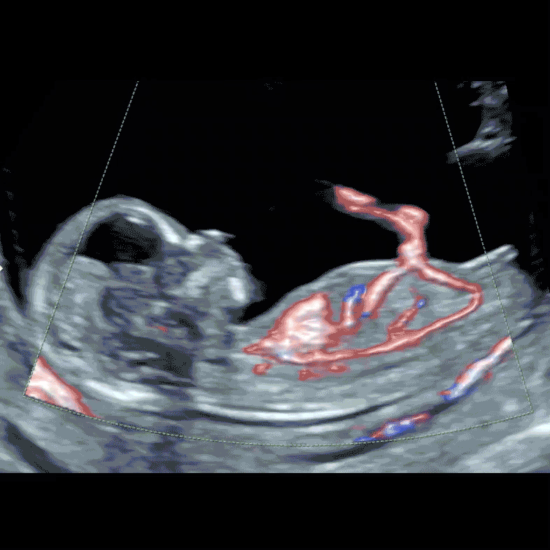 Baby's heart, main arterial and venous vessels and umbilical cord blood flow by our special colour Doppler technology. Image done during London Pregnancy Clinic's Early Baby Heart Scan, or Early Fetal Echocardiography, at 12 weeks