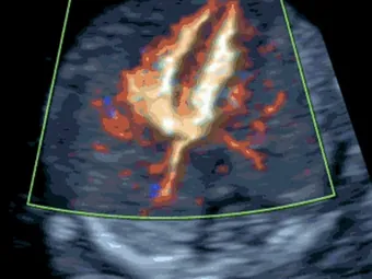12–18 weeks: Early Fetal Echocardiography