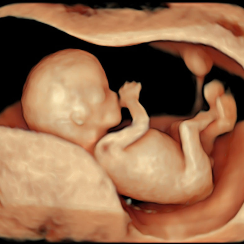 Normal Early pregnancy scans at 12wk 3D.