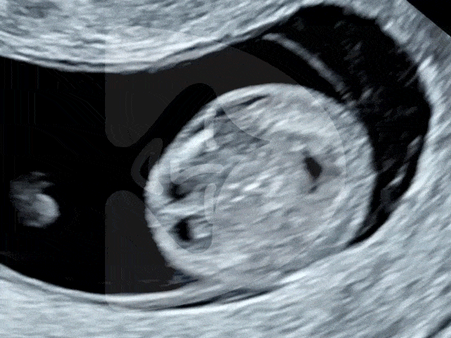 Ultrasound GIF of baby's brain at 10 weeks. Image by London Pregnancy Clinic - for educational purpose.