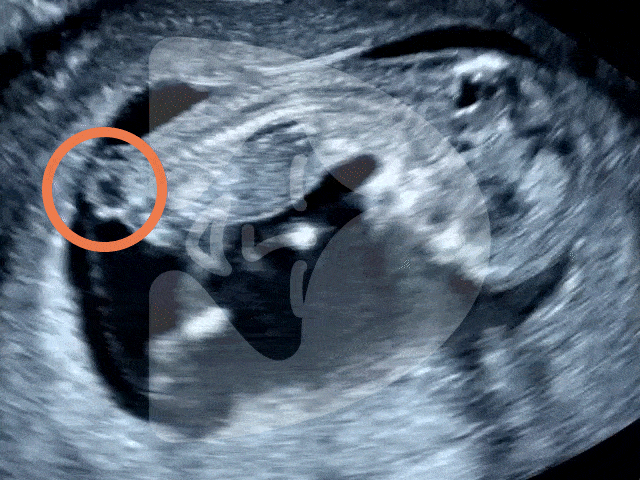Ultrasound GIF of baby with spina bifida at 11 weeks. Spina bifida cystica is seen at the bottom of the spine. Image by London Pregnancy Clinic - for educational purpose.