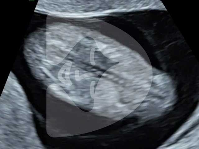 Ultrasound GIF of baby's spine at 10 weeks. Image by London Pregnancy Clinic - for educational purpose.