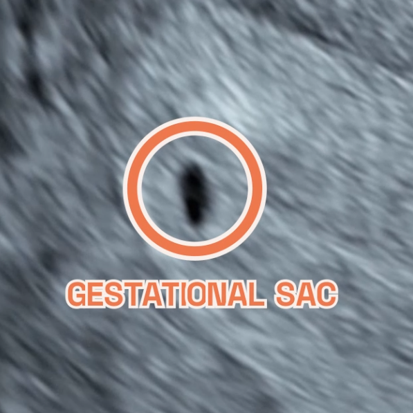 Image showing a intrauterine pregnancy at 4 weeks of pregnancy on ultrasound. It shows an Ultrasound image by London Pregnancy Clinic that shows the gestational sac and how small it is - for educational purpose.