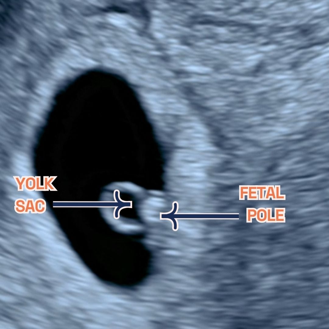 Image showing what would an ultrasound show at 6 weeks of pregnancy. You can see the fetal pole, gestational sac and yolk sac. It shows an Ultrasound image by London Pregnancy Clinic that shows the gestational sac and how small it is - for educational purpose.