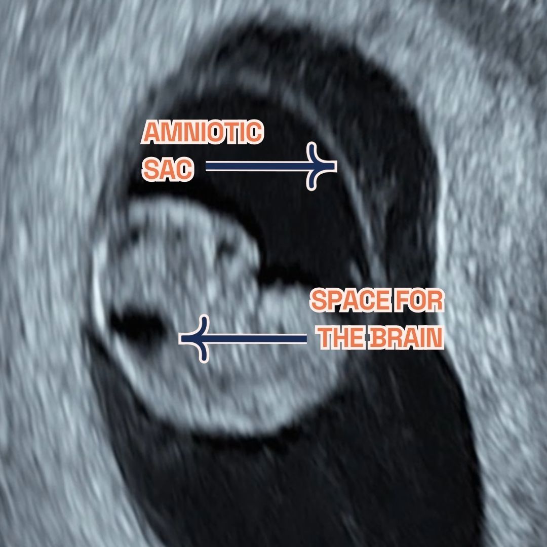 Image showing what would an ultrasound show at 8 weeks of pregnancy. It shows an Ultrasound image by London Pregnancy Clinic that shows the gestational sac, fetal pole, amniotic sac and yolk sac - for educational purpose.