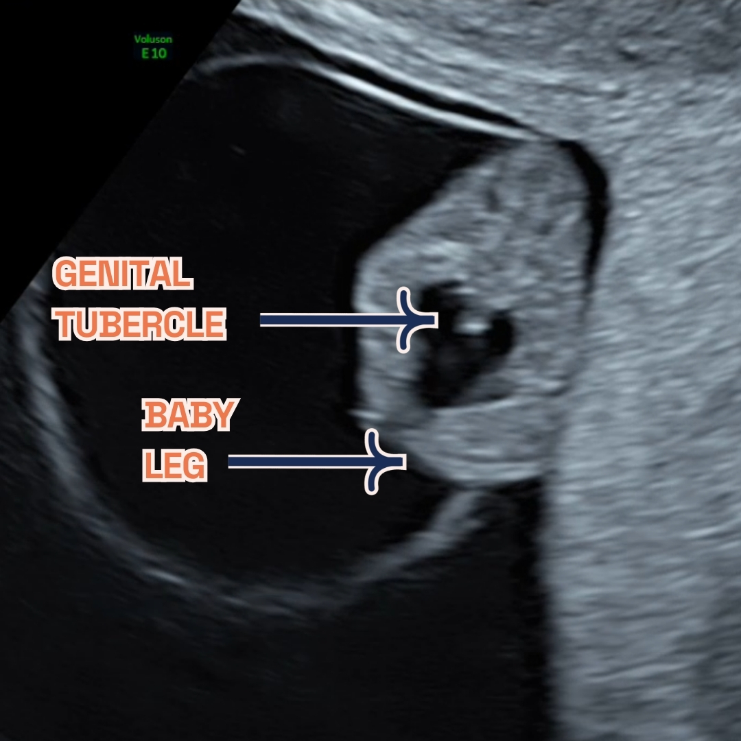 Gestational sac, fetal leg and Genital Tubercle at 9 weeks of pregnancy as seen on ultrasound scan.